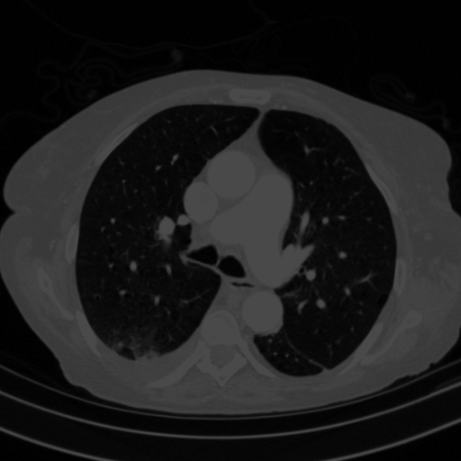 Original VENOUS CT scan