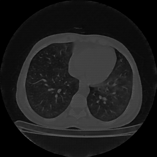 Reconstructed NATIVE CT scan (cycle consistency)