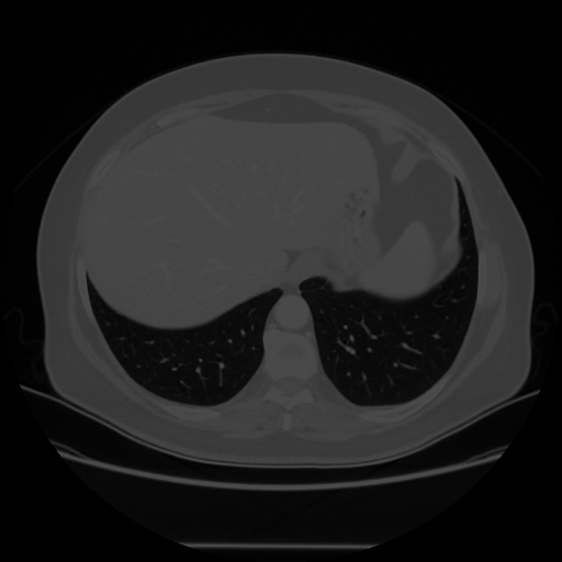 Original VENOUS CT scan