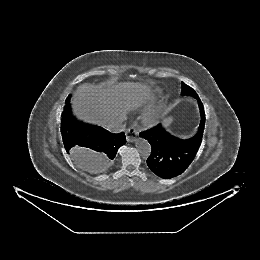 Reconstructed NATIVE CT scan (cycle consistency)
