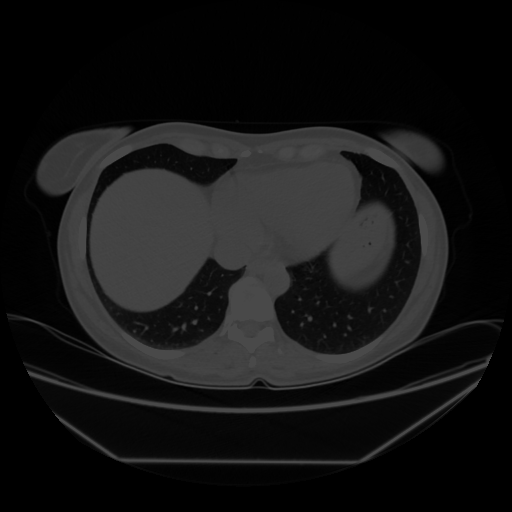 Original NATIVE CT scan (input)