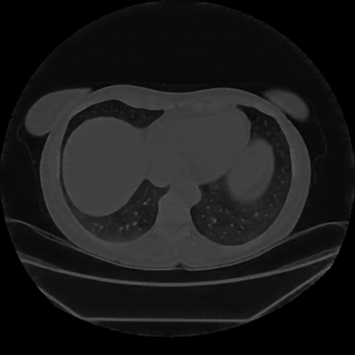 Reconstructed NATIVE CT scan (cycle consistency)