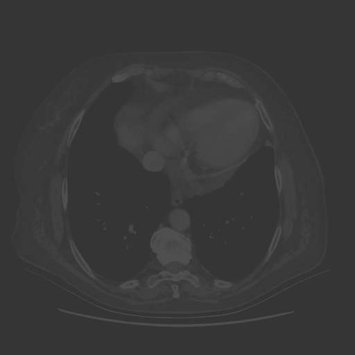 Original VENOUS CT scan