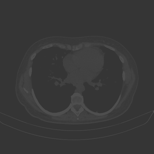 Original NATIVE CT scan (input)