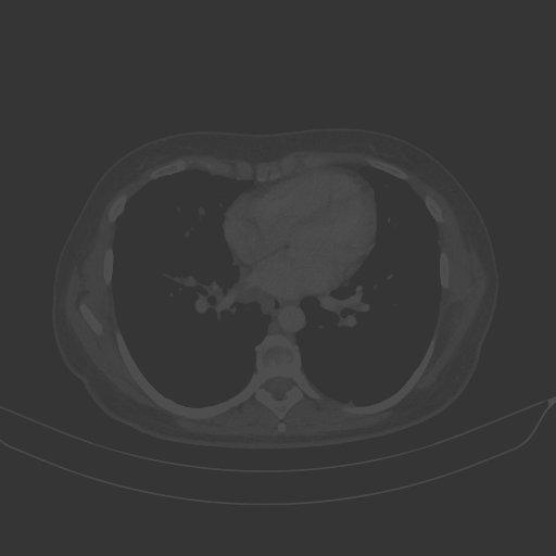 Original VENOUS CT scan
