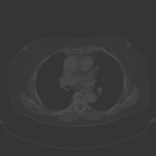 Original VENOUS CT scan