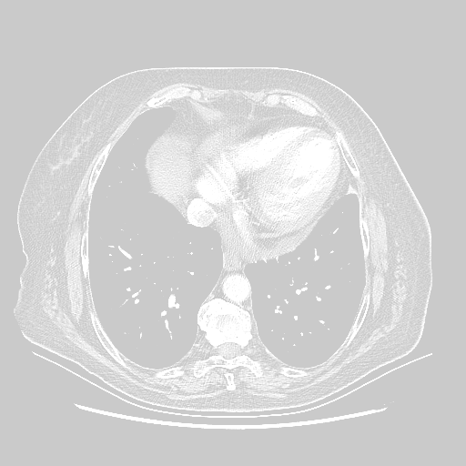 Original NATIVE CT scan (input)