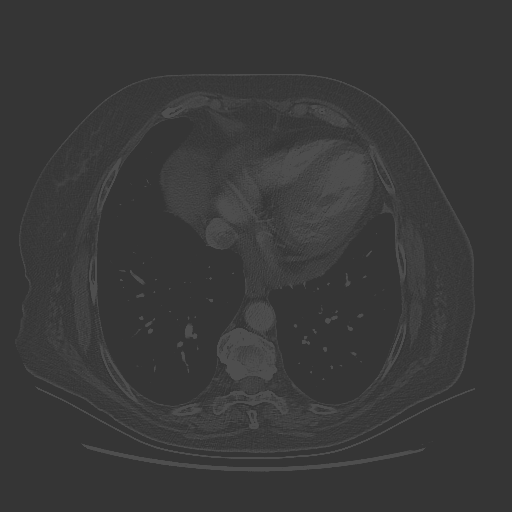 Original NATIVE CT scan (input)