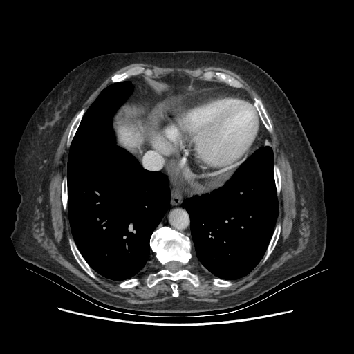 Original VENOUS CT scan