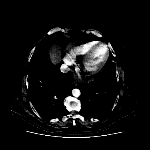 Reconstructed NATIVE CT scan (cycle consistency)