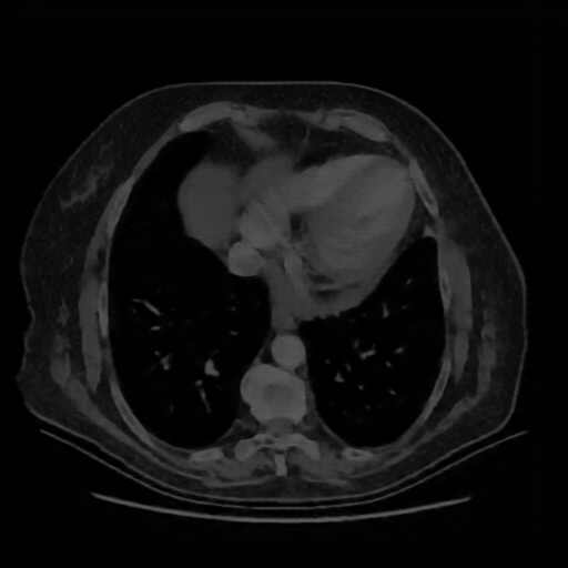 Reconstructed NATIVE CT scan (cycle consistency)