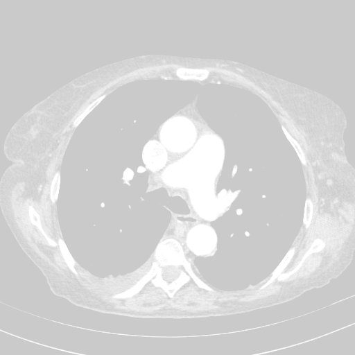 Original VENOUS CT scan