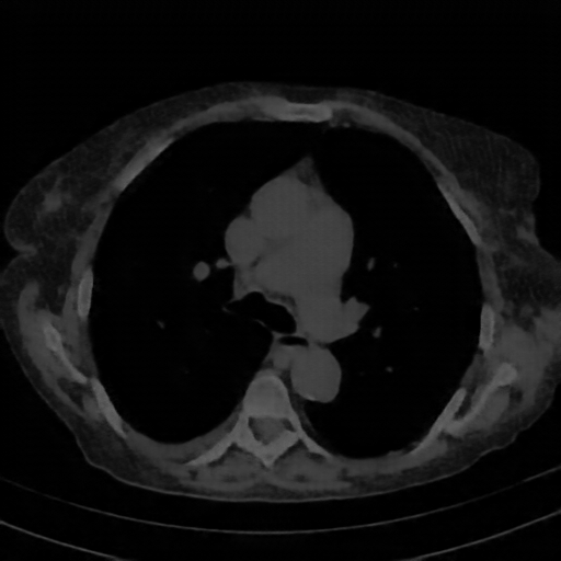 Reconstructed NATIVE CT scan (cycle consistency)