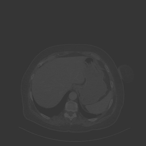 Original VENOUS CT scan