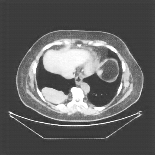 Generated VENOUS CT scan (A→B translation)