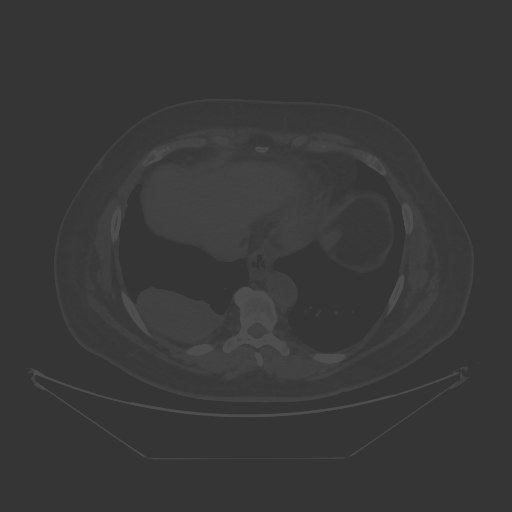 Original NATIVE CT scan (input)