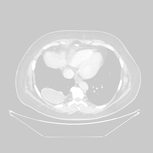 Original VENOUS CT scan