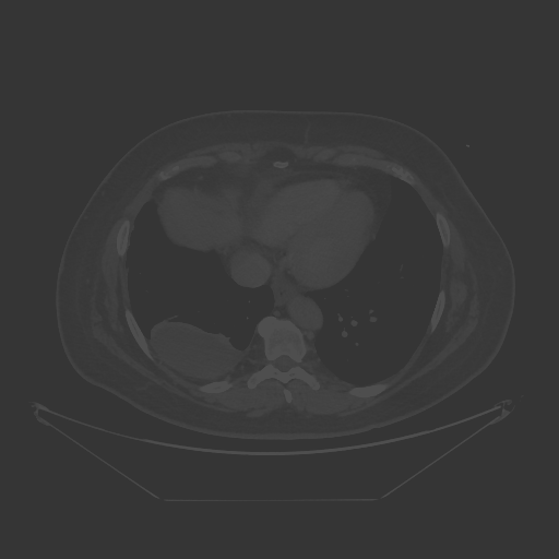 Original VENOUS CT scan