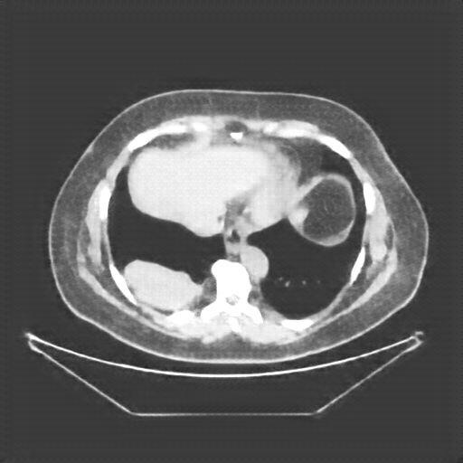 Reconstructed NATIVE CT scan (cycle consistency)