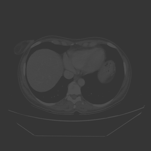 Original VENOUS CT scan
