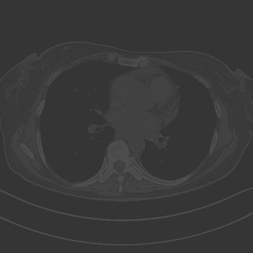 Original NATIVE CT scan (input)