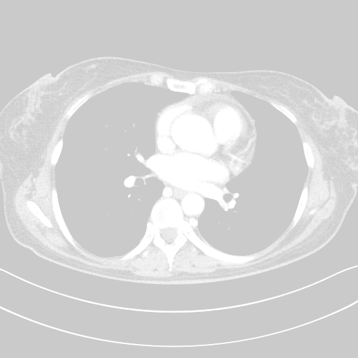 Original VENOUS CT scan