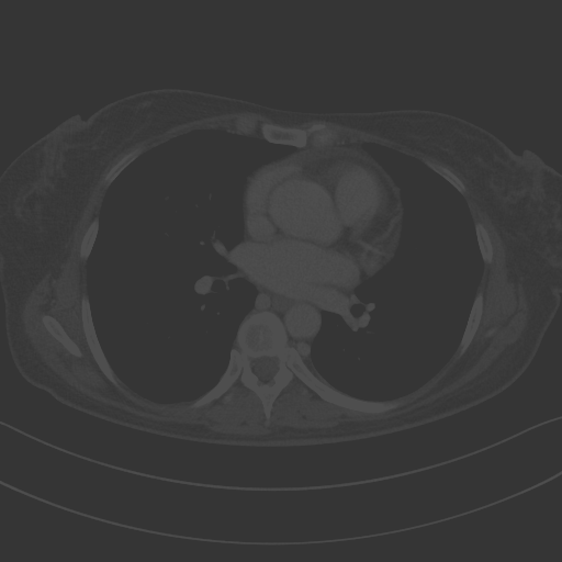 Original VENOUS CT scan