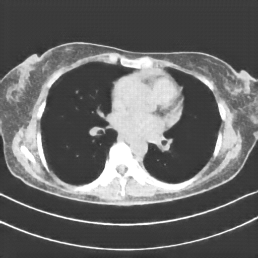 Reconstructed NATIVE CT scan (cycle consistency)