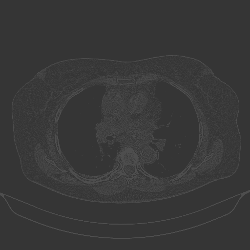 Original NATIVE CT scan (input)