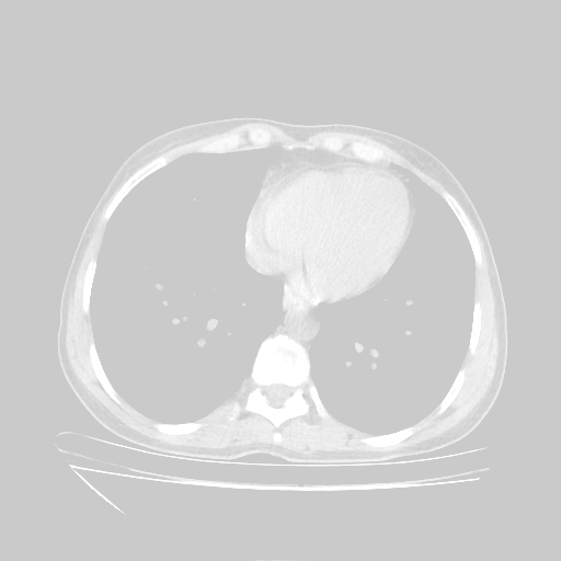 Original NATIVE CT scan (input)