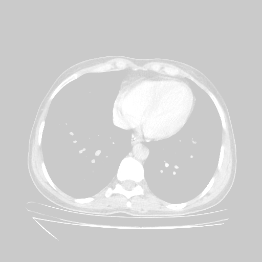 Original VENOUS CT scan