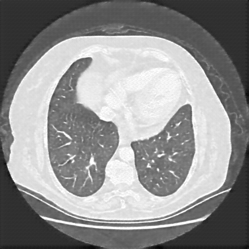 Reconstructed NATIVE CT scan (cycle consistency)