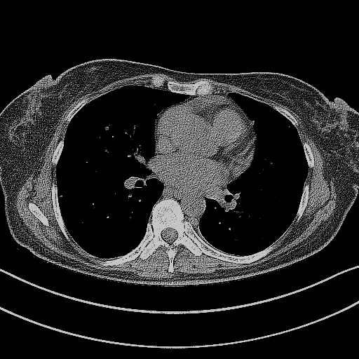 Original NATIVE CT scan (input)