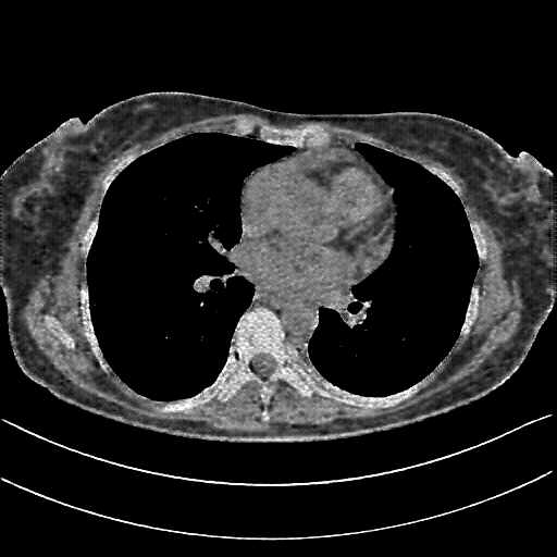 Reconstructed NATIVE CT scan (cycle consistency)