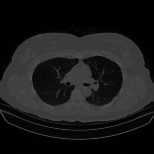 Reconstructed NATIVE CT scan (cycle consistency)