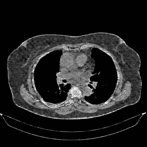 Reconstructed NATIVE CT scan (cycle consistency)