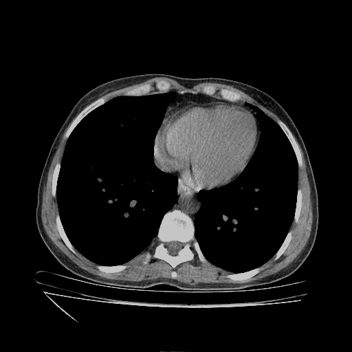 Original NATIVE CT scan (input)