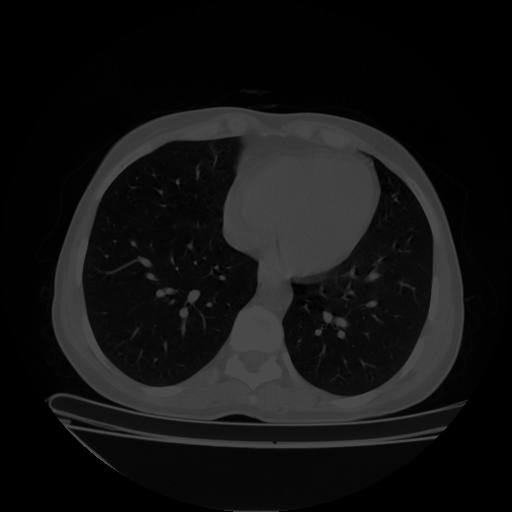 Original NATIVE CT scan (input)