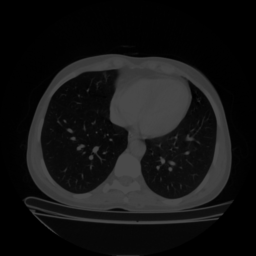 Original VENOUS CT scan