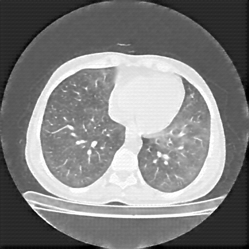 Reconstructed NATIVE CT scan (cycle consistency)