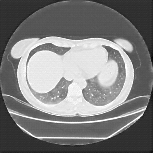 Reconstructed NATIVE CT scan (cycle consistency)