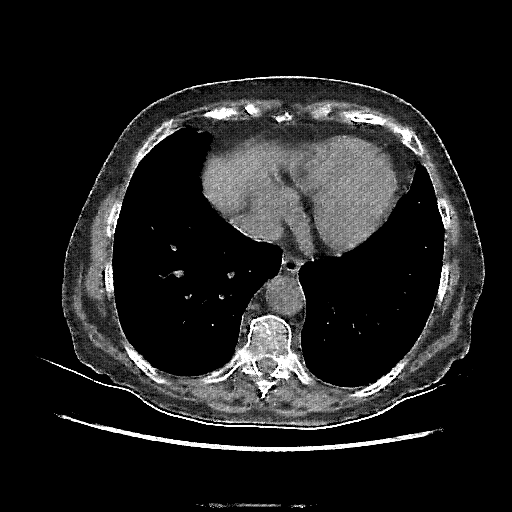 Reconstructed NATIVE CT scan (cycle consistency)