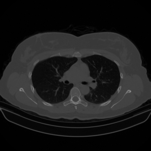 Original NATIVE CT scan (input)