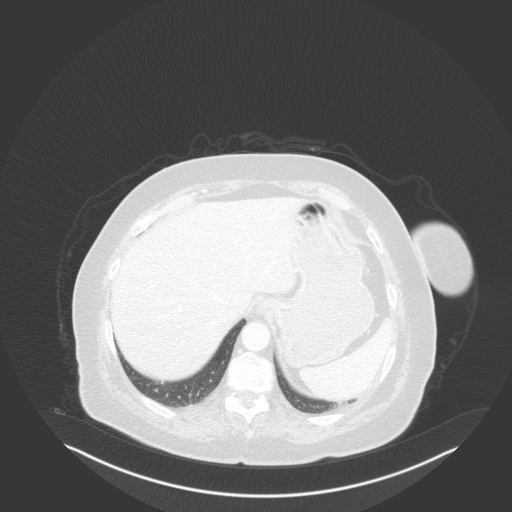 Original VENOUS CT scan