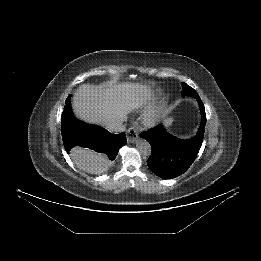 Reconstructed NATIVE CT scan (cycle consistency)