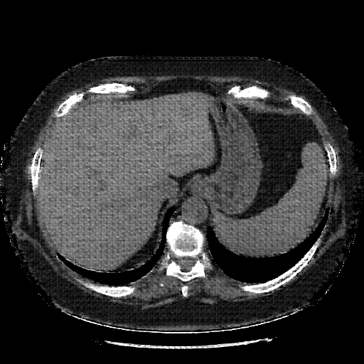 Reconstructed NATIVE CT scan (cycle consistency)
