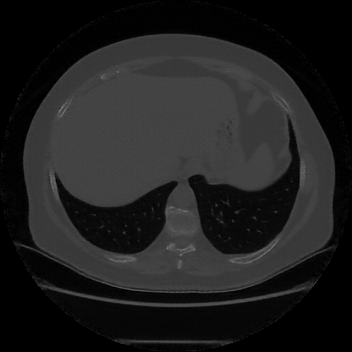 Reconstructed NATIVE CT scan (cycle consistency)