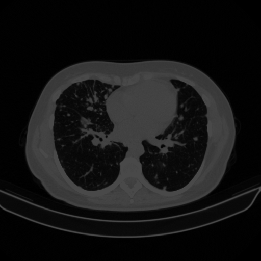 Original NATIVE CT scan (input)