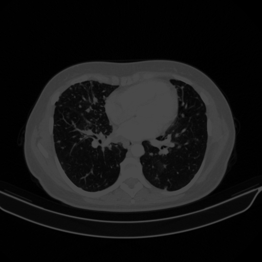 Original VENOUS CT scan