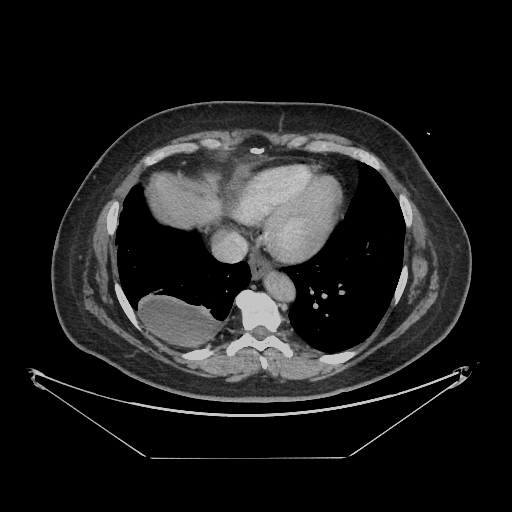 Original VENOUS CT scan